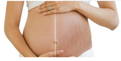  产后祛除妊娠纹的较佳时期