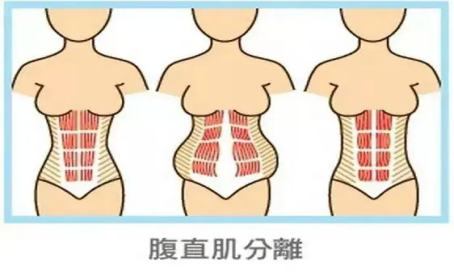 产后腹直肌修复和盆底肌修复哪个更重要