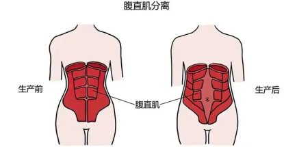  产后腰痛需重视腹直肌分离问题