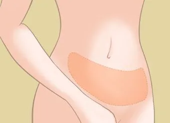 产后腹部吸脂，剖腹产后多久可以做腰腹吸脂