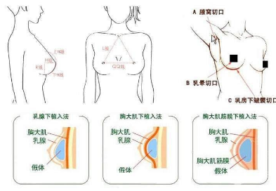 产后胸部严重下垂整形会变小吗