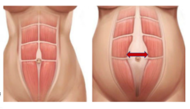 产后腹直肌分离怎么修复，有用吗