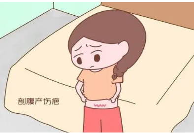 产后剖腹产疤痕怎么修复