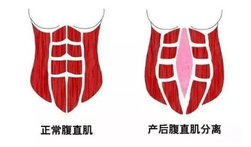 产后腹直肌分离一指是正常的吗